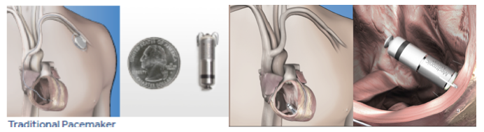Figure 2.  Comparison of traditional transvenous pacemaker system with MICRA leadless system – comparable to the size of a quarter- now placed in the bottom right ventricle of the heart with tines securing its position without the need for a wired system and traditional pacemaker placed in the upper chest. 